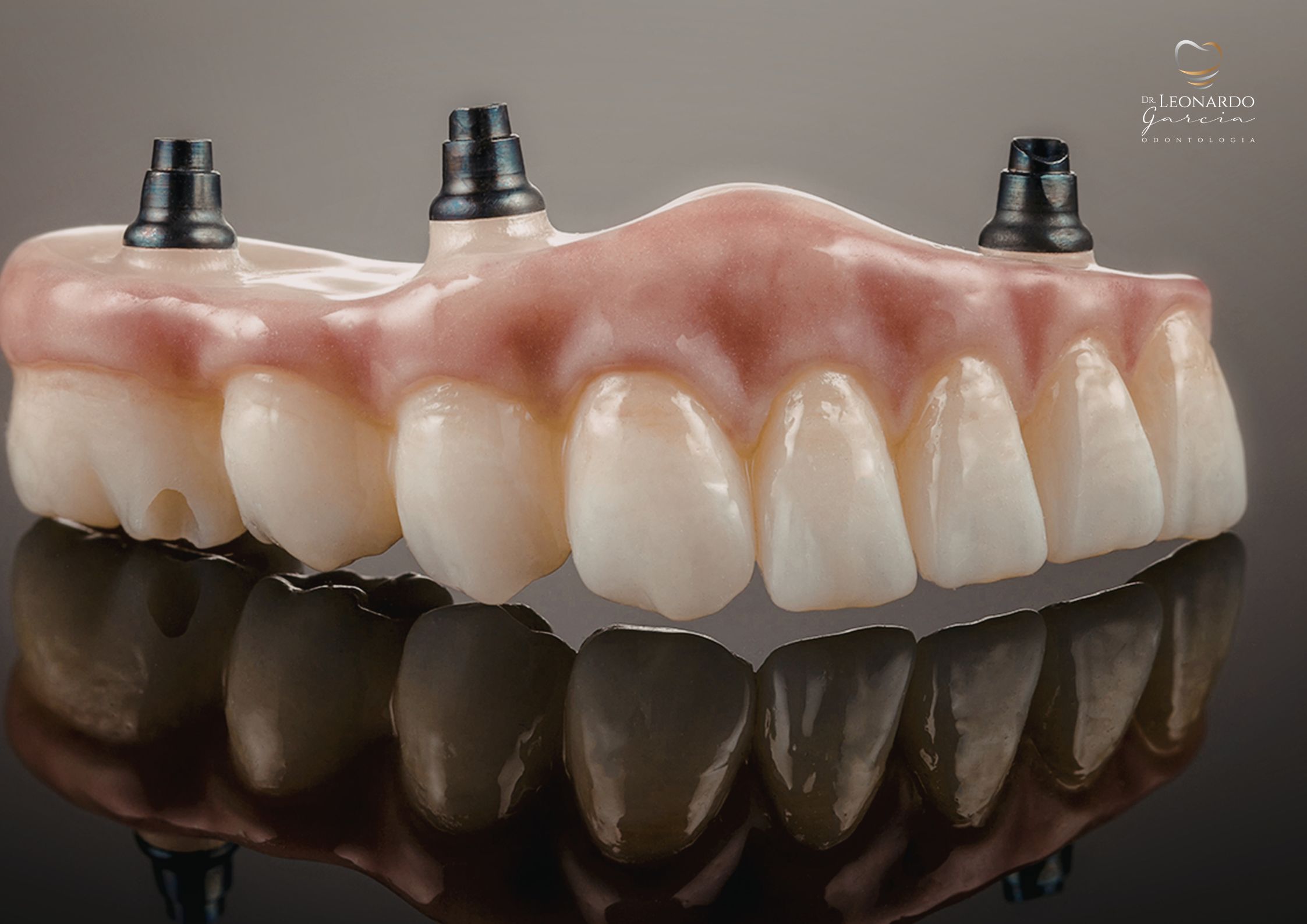 Prótese sobre Implante